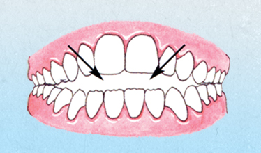diagram of Open Bite